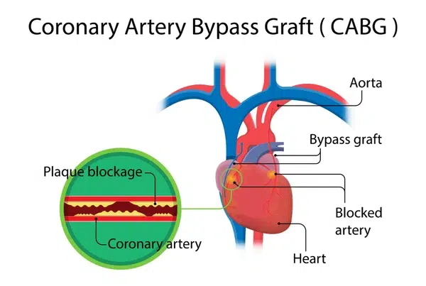 CABG heart bypass surgery India Malaysia