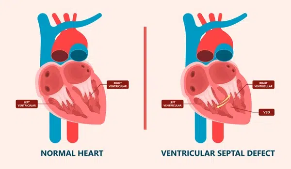 Pediatric heart surgery ASD VSD repair India