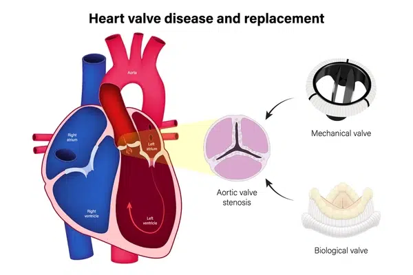 Heart valve replacement repair surgery India