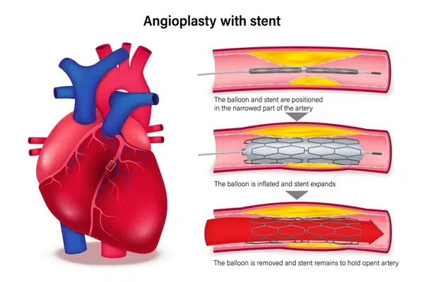 Coronary angioplasty stenting India Malaysia